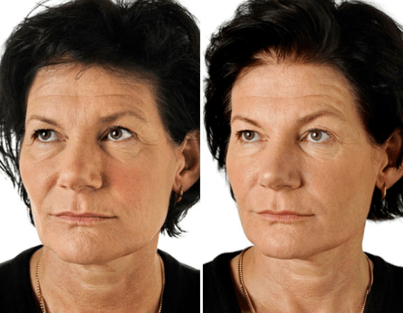 Näo murdosa noorendamise tulemus