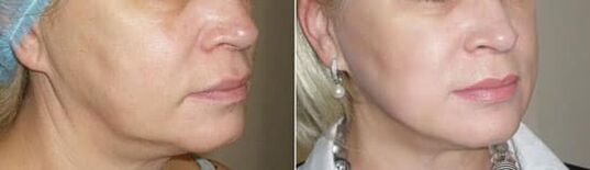 Foto pärast protseduuri rakendamist