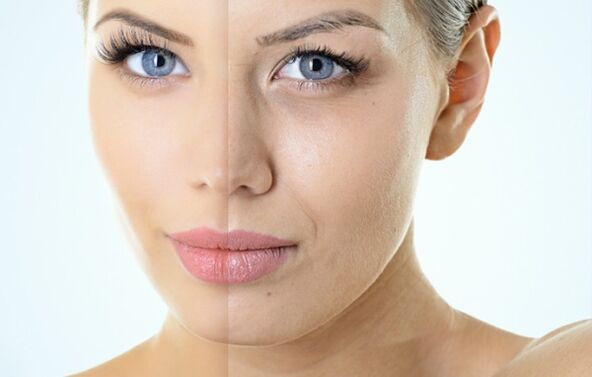 Fraktsionaalse noorendamise näidustused