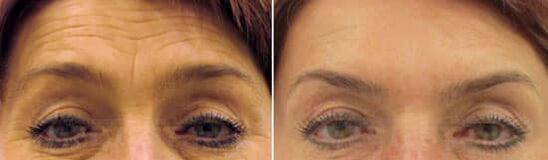 Välisseemiku noorendamine